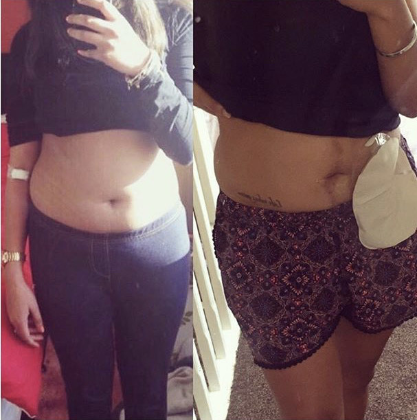 Aleesha Before And After
