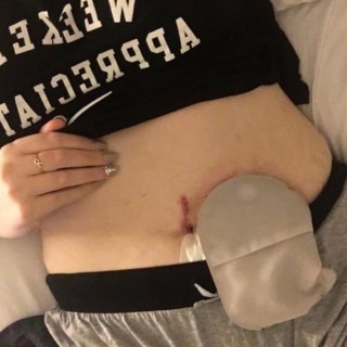 Jen McGregor Ostomy Blog
