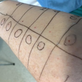 Allergy Testing Urostomy Blog