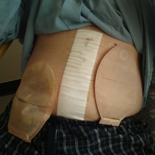 My Stoma Bags Nick Axtell