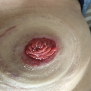 Michelle Williams Parastomal Hernia Blog