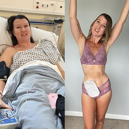 life with ileostomy bag