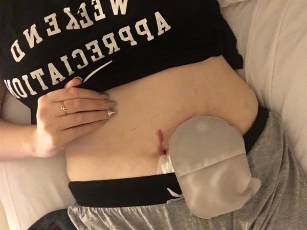 Jen McGregor Ostomy Blog