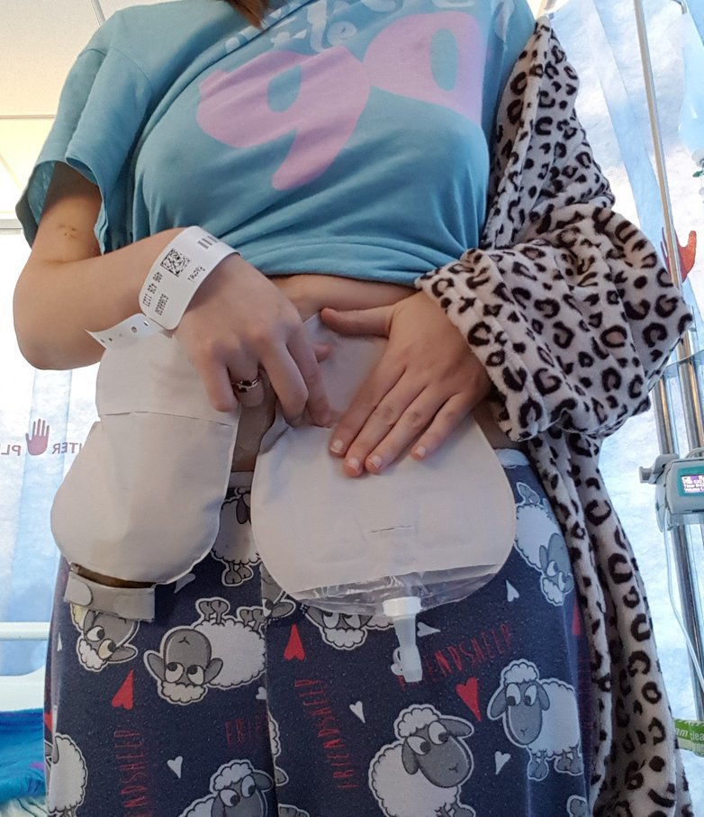 Changing a urostomy bag step 7 Changing a urostomy bag step 7