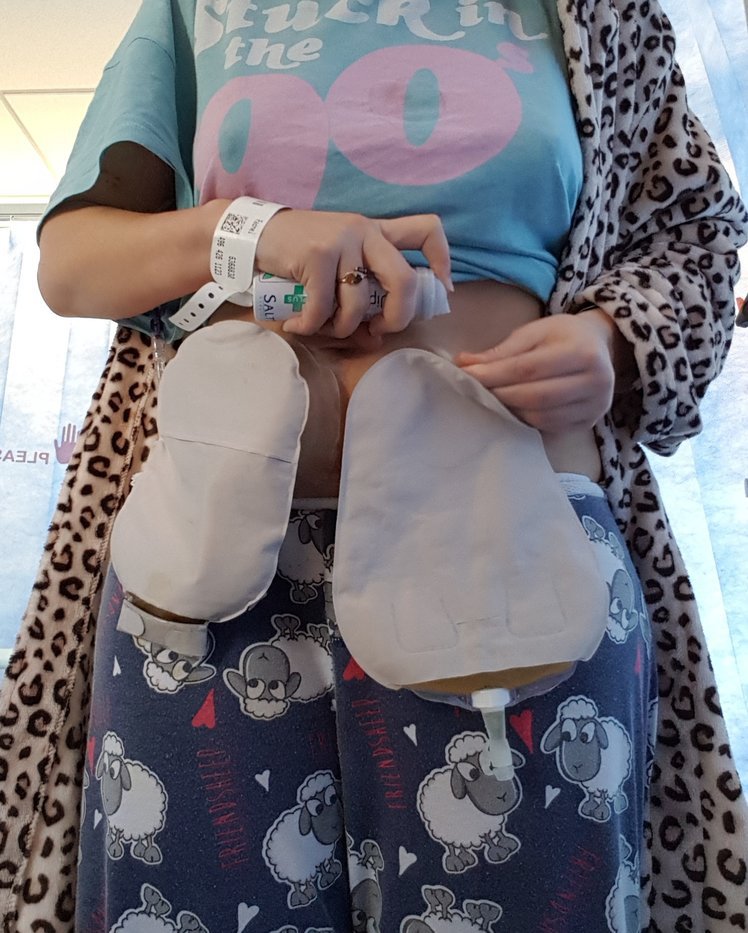 Changing a urostomy bag step 1 Changing a urostomy bag step 1
