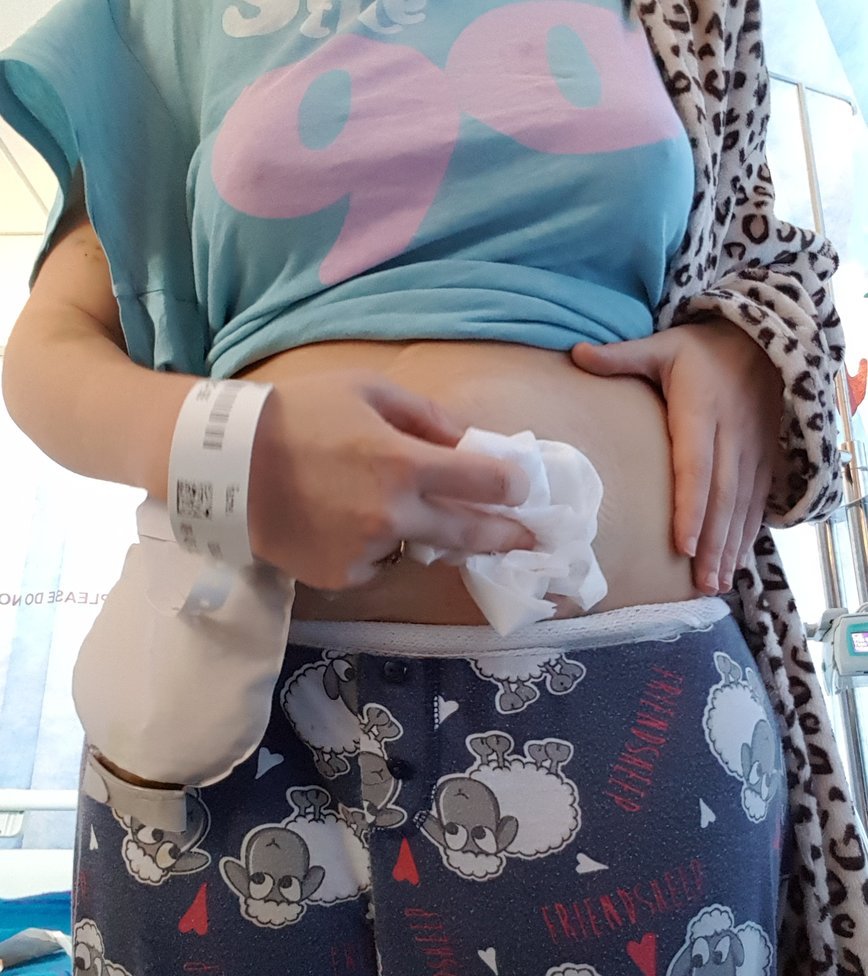 Changing a urostomy bag step 2 Changing a urostomy bag step 2