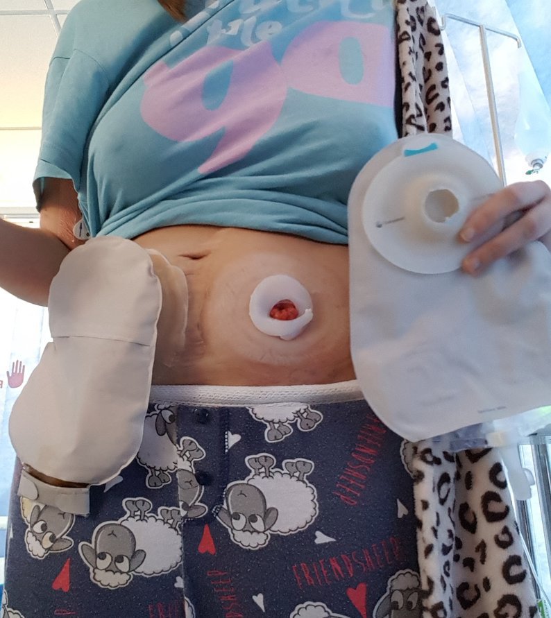 Changing a urostomy bag step 7