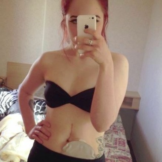 Hattie’S Stoma Journey Month 2 After Stoma Surgery