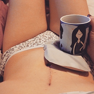 Hattie’S Stoma Journey Month 1 After Ileostomy Surgery