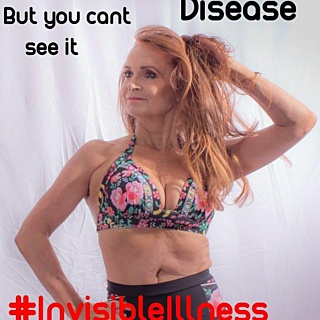 Inspiring Others Raising Awareness And Paying Tribute – My Photo Shoot With My Stoma Bag Internal Pic