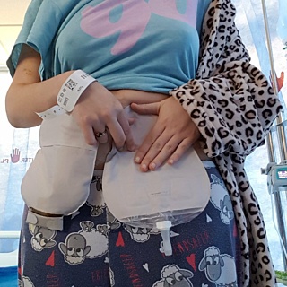 Urostomy Bag Change Blog 1