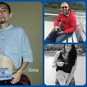 What Is Life Like With A Stoma Around The World