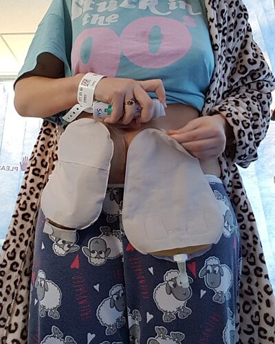 Urostomy Bag Change Blog 2