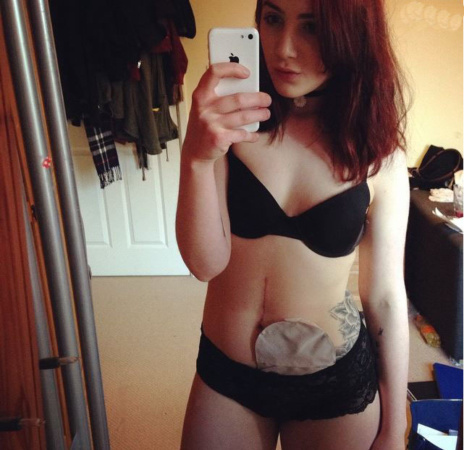 Hattie’S Stoma Journey Month 4 After Surgery