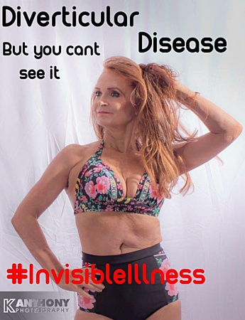 Inspiring Others Raising Awareness And Paying Tribute – My Photo Shoot With My Stoma Bag Internal Pic